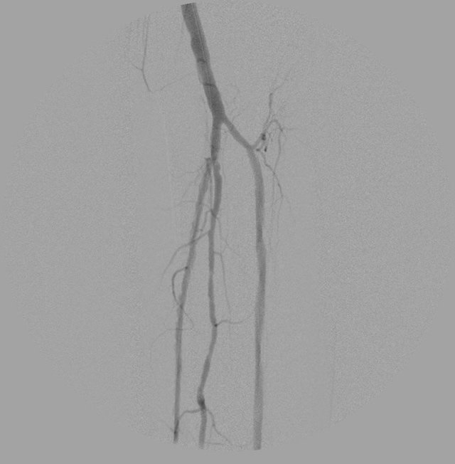vArterial flow through calf after the intervention. All 3 arterial branches are present and flowing, amputation not needed.