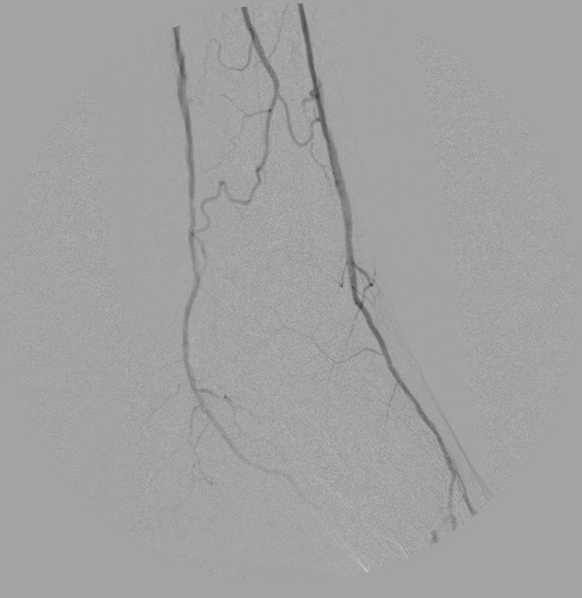 Arterial flow through calf after the intervention. All 3 arterial branches are present and flowing, second image.