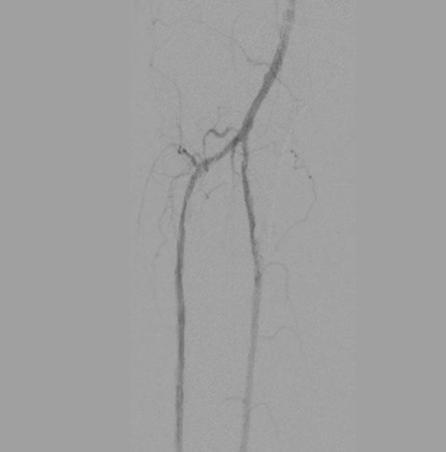 After image of intervention to clear the arterial blockages establishing flow through the two lower branches of the arteries.