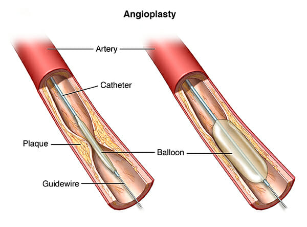 angioplasty - Pedes Orange County
