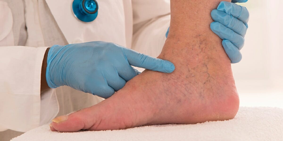 Chronic Venous Insufficiency - Signs, Symptoms, & Complications