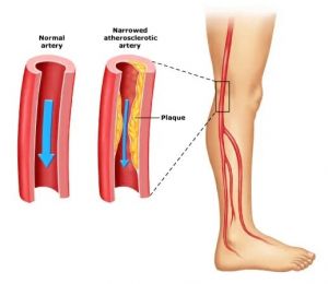Peripheral Artery Disease - Diagnosis