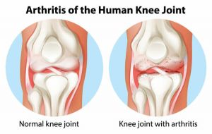 Signs and Symptoms of Osteoarthritis (OA)
