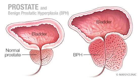 benign prostate hyperplasia (BPH) treatment - Pedes Orange County
