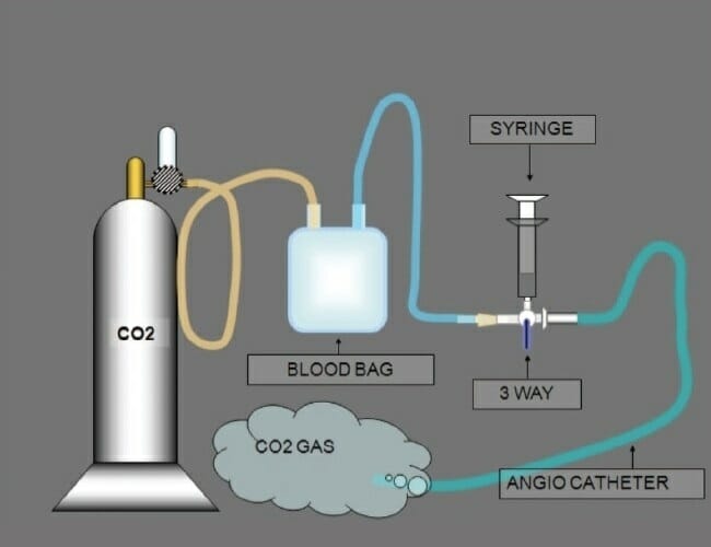 CO2 angiography (venography) - Pedes Orange County