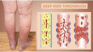 deep vein thrombosis (DVT)