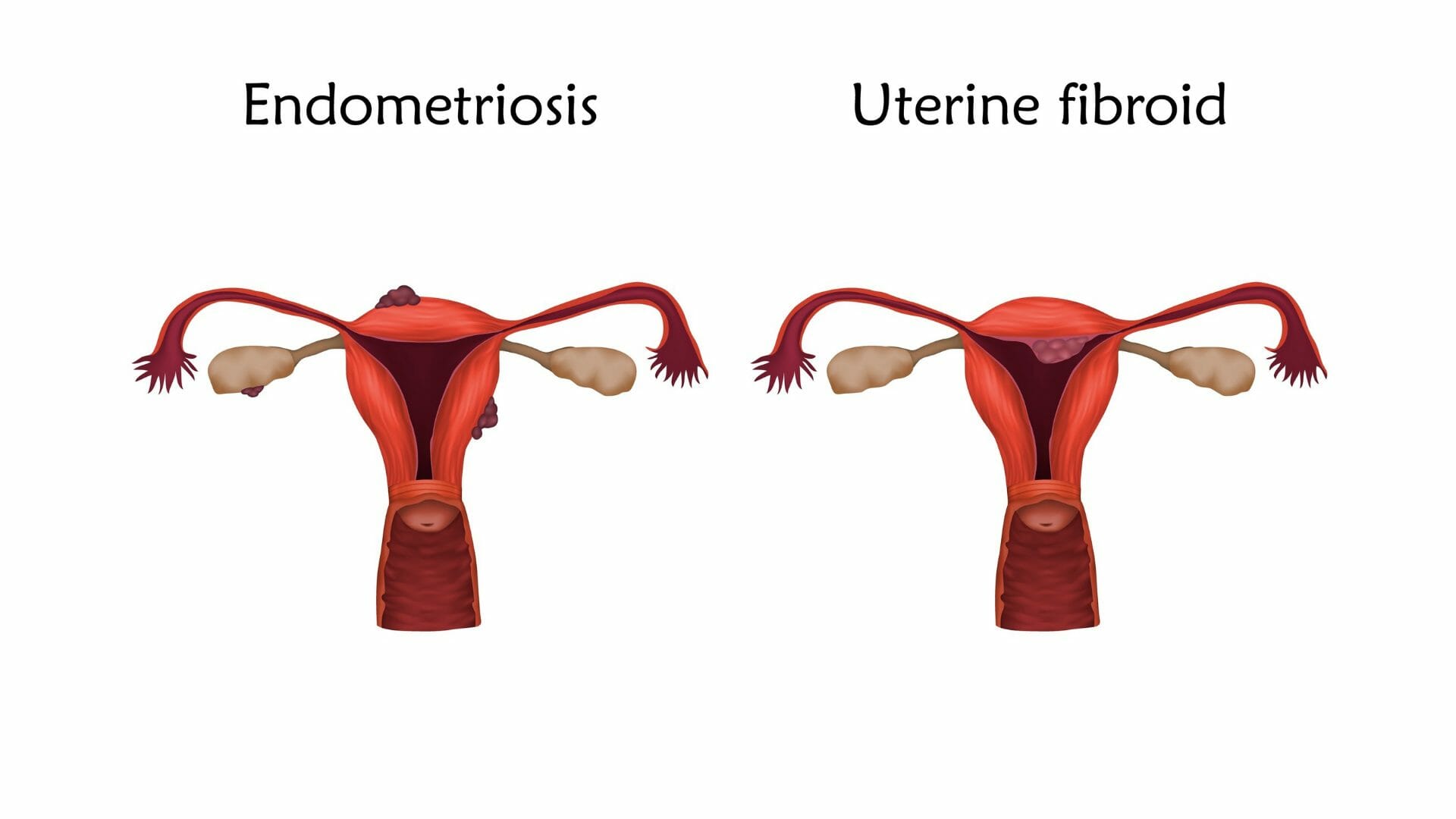 Benefits and risks associated with uterine embolization treatment