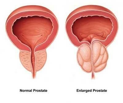 benign prostate hyperplasia (BPH) - Pedes Orange County