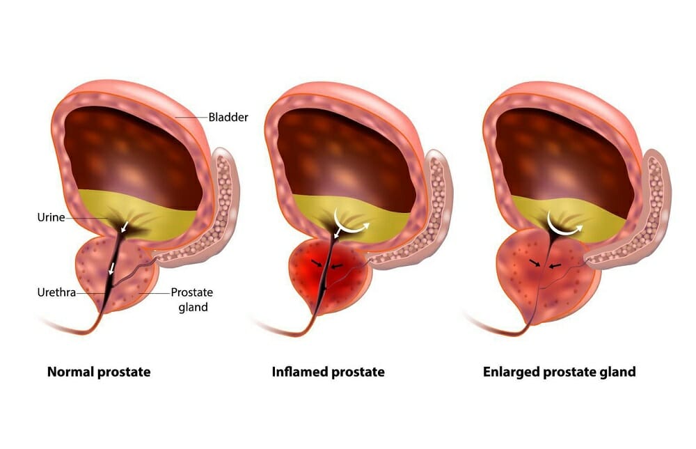 Prostate Artery Embolization (PAE)