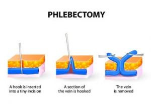 Microphlebectomy - phlecbectomy - Pedes Orange County