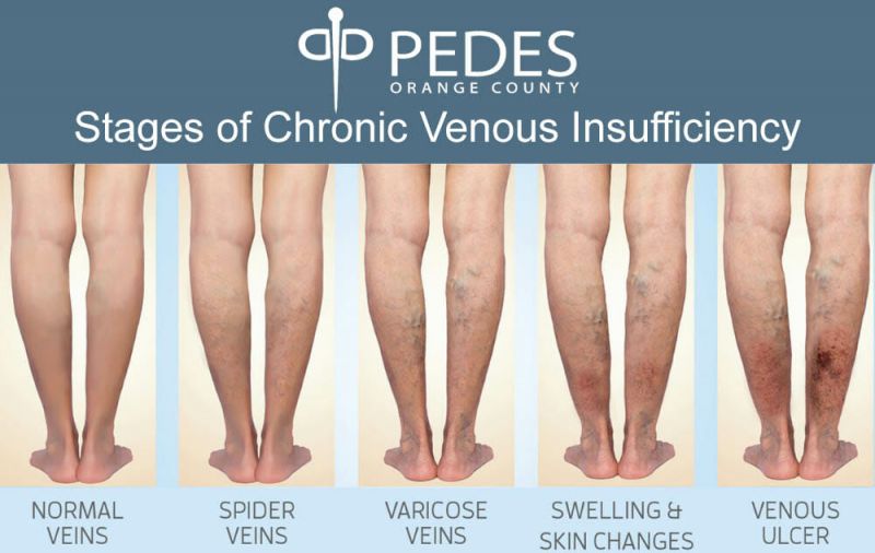 Chronic Venous insufficiency | Peripheral Venous Disease | Vein Disease