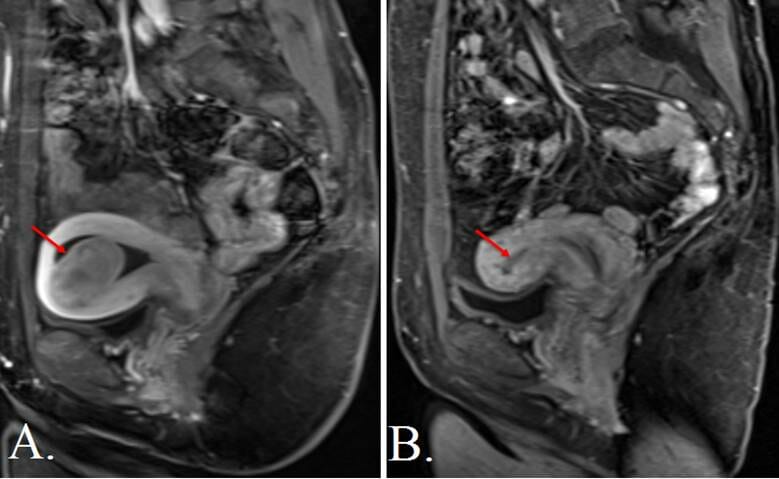 uterine fibroids magnetic resonance imaging (MRI)