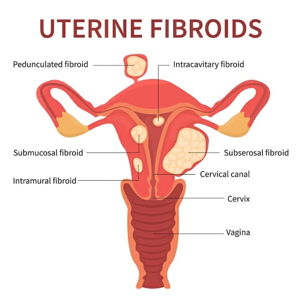 uterine fibroids - Pedes Orange County