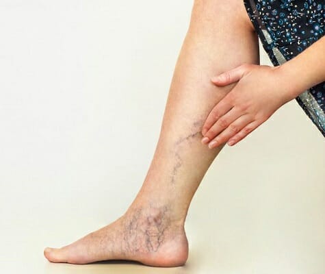 vascular disease, woman showing venous disease on legs