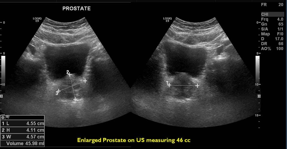 Benign prostatic hyperplasia ultrasound image. image shows enlarged prostate.
