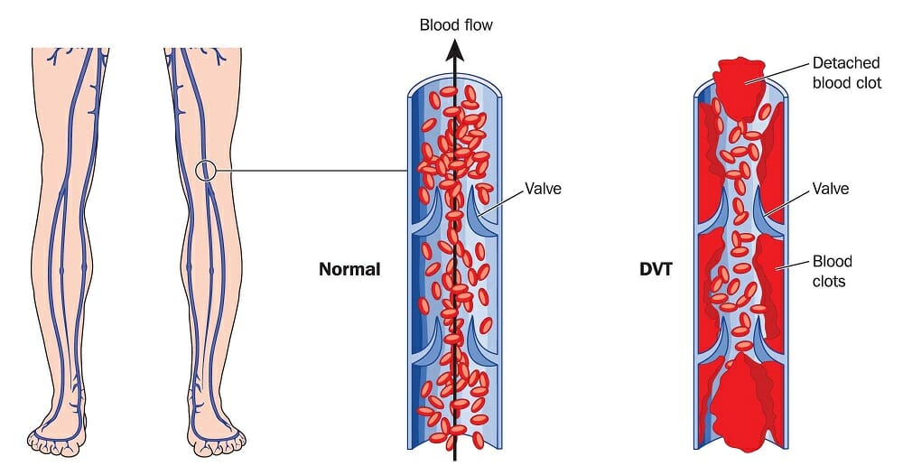 deep vein thrombosis (DVT)