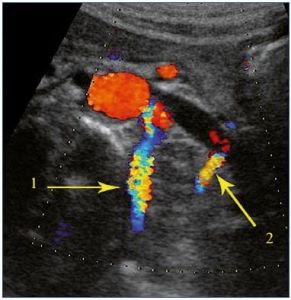 pelvic venous congestion - Doppler ultrasound 