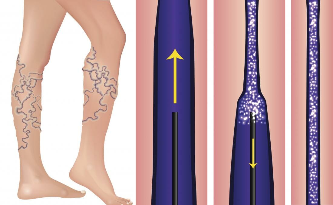 Sclerotherapy - Pedes Orange County