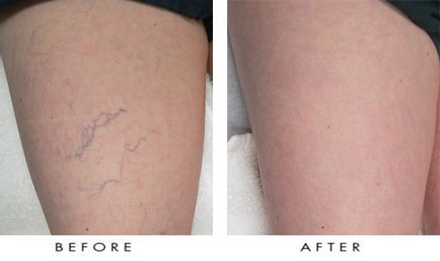 spider veins treatment before and after - Pedes Orange County