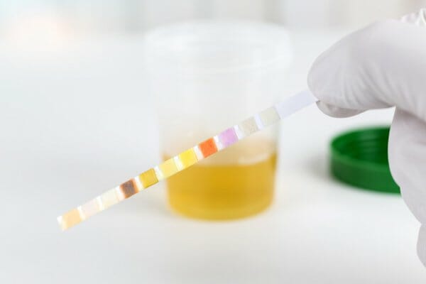 benign prostate hyperplasia (BPH) urine test - Pedes Orange County