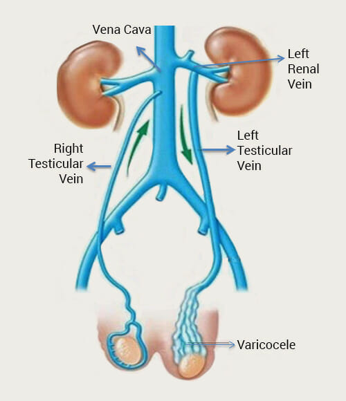 Varicoceles Varicocele Treatment Pedes Orange County