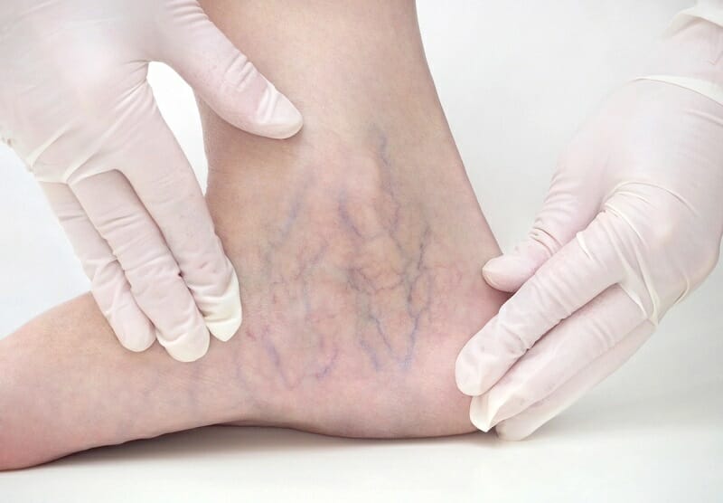 What are reticular veins