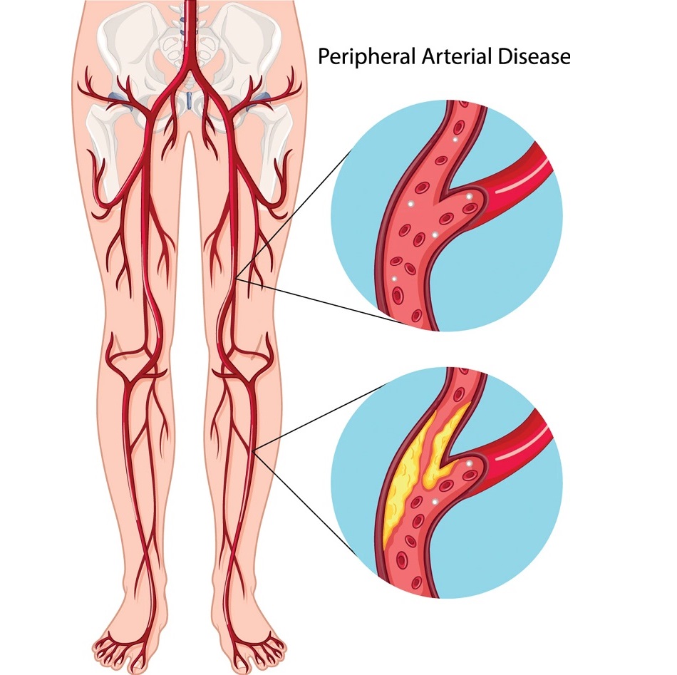 Treatments for Peripheral Arterial Disease