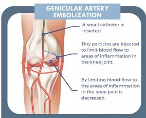 Genicular Artery Embolization at Pedes Orange County