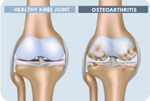 Healthy Knee Joint vs. Osteoarthritis 