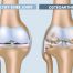 Healthy Knee Joint vs. Osteoarthritis