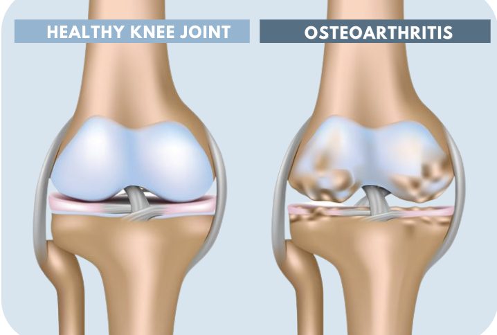 Healthy Knee Joint vs. Osteoarthritis