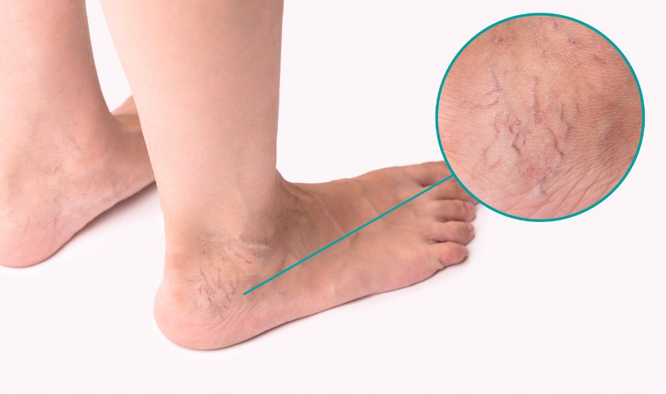 Varicose vein in the feet