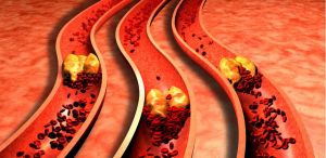 artery plaque buildup peripheral artery disease