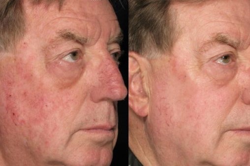 before and after images of patient's face demonstrate effectiveness of the excel v laser on treating broken blood vessels.