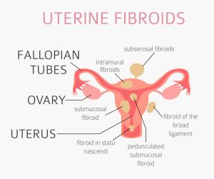 Uterine fibroids Ginecological medical desease in women