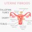 Uterine fibroids Ginecological medical desease in women