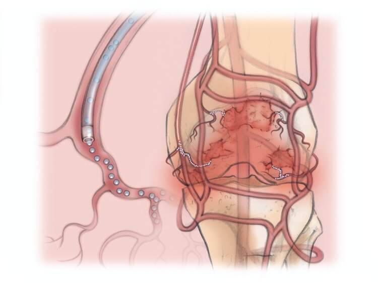 genicular artery embolization