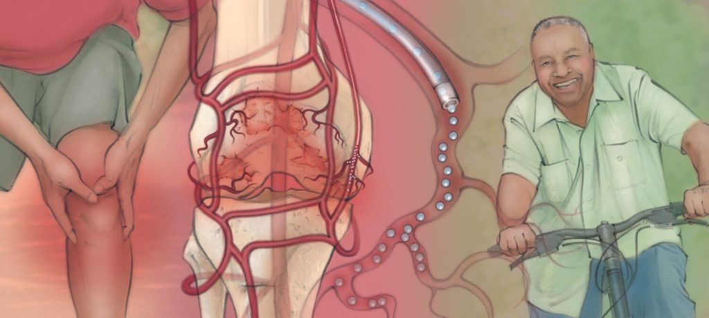 genicular artery embolization