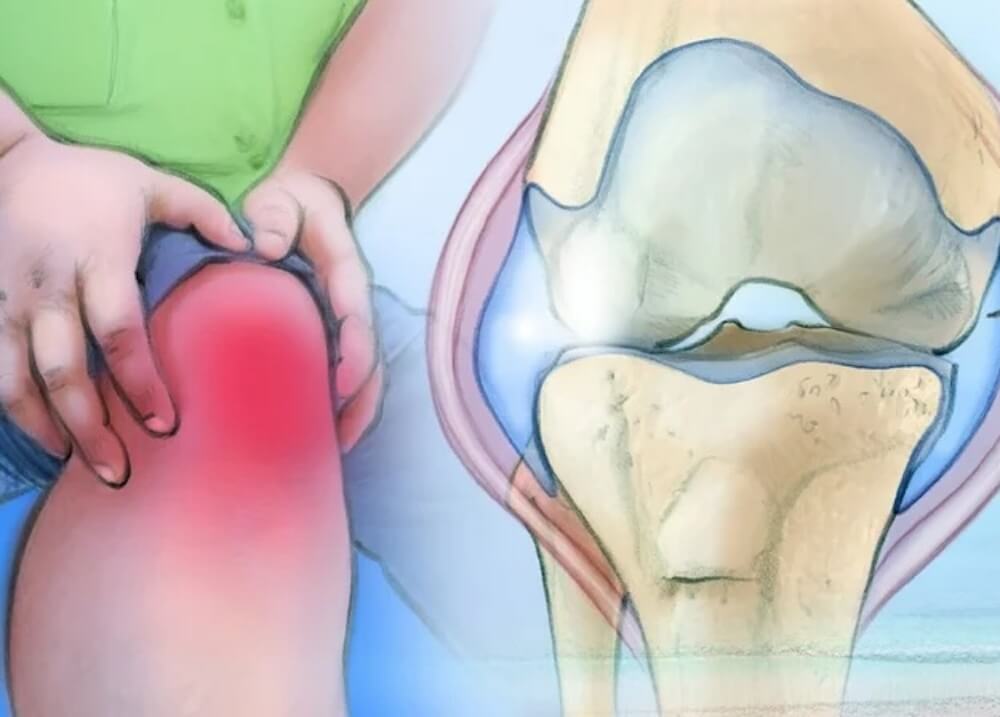 knee osteoarthritis