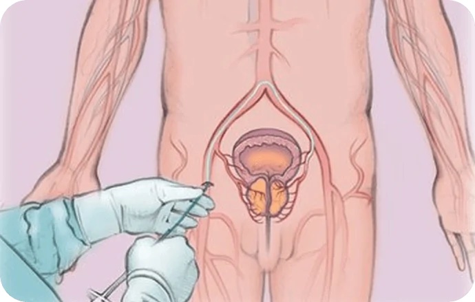 pae procedure
