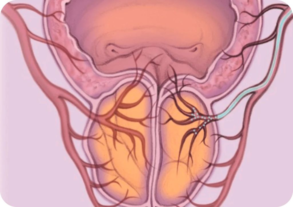 prostate artery embolization
