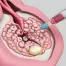 Illustration of uterine fibroid embolization procedure showing catheter delivering particles to block blood flow to fibroids