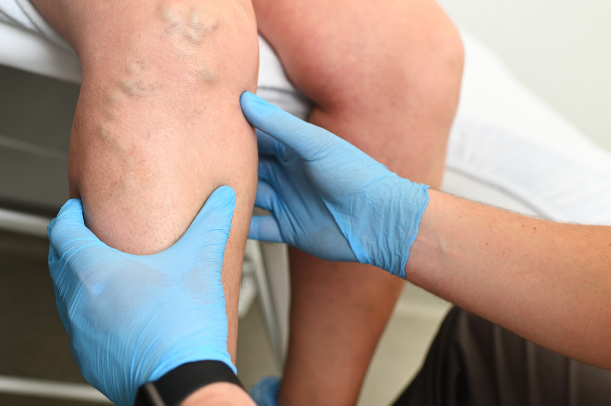 vein doctor examines a patient with varicose veins on his leg.