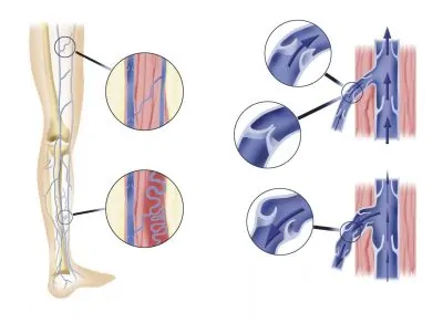 chronic venous insufficiency