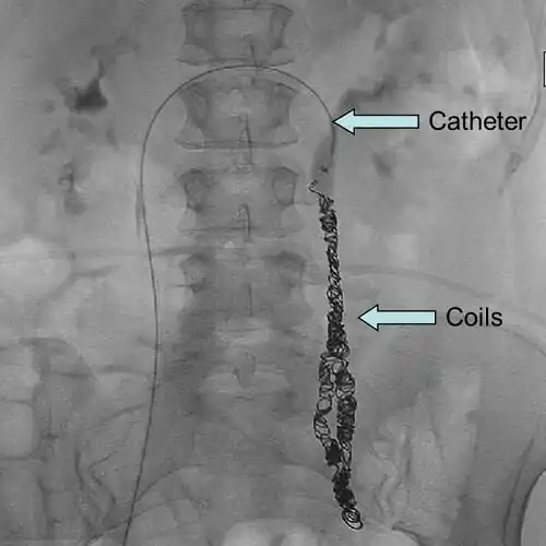 pelvis venous embolization