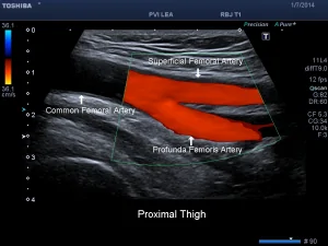 duplex ultrasound
