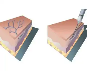 sclerotherapy