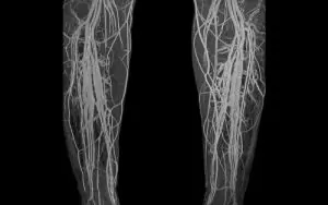 venogram