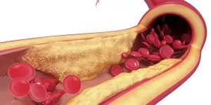 blood vessel with blood cells flowing between plaque.