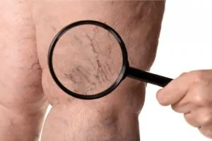 chronic venous insufficiency (CVI) - Pedes Orange County